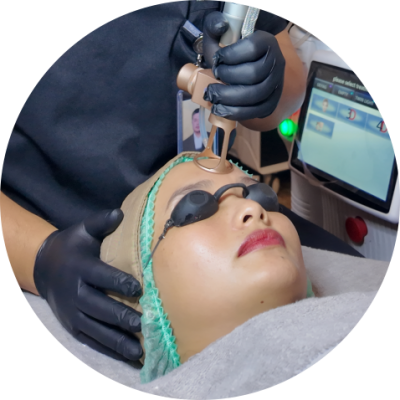 Treatment - Laser CO2 (Original)