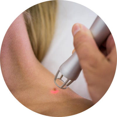 Treatment - Laser Skintag